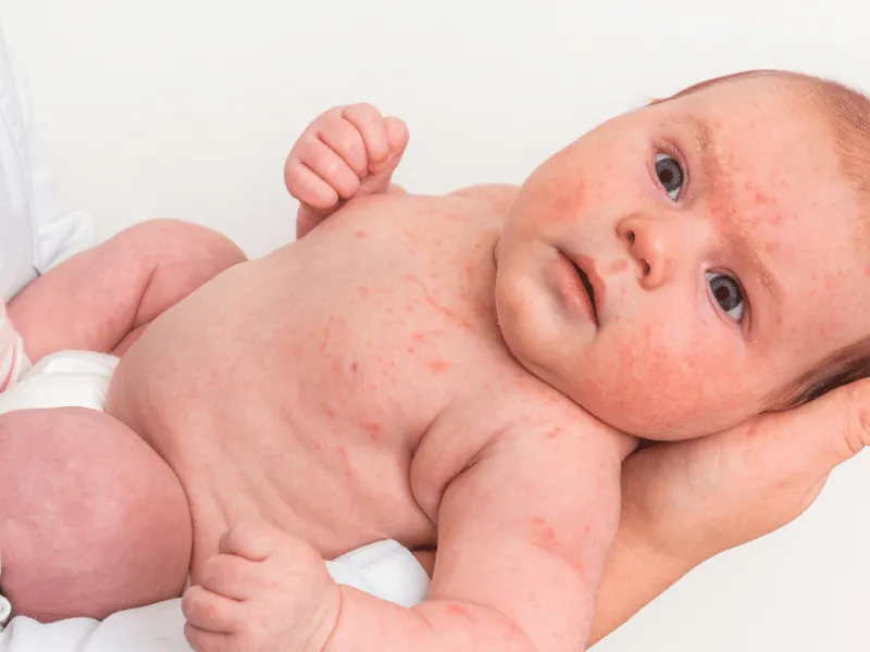 Trẻ bị mẩn ngứa ở cổ là bệnh gì? 