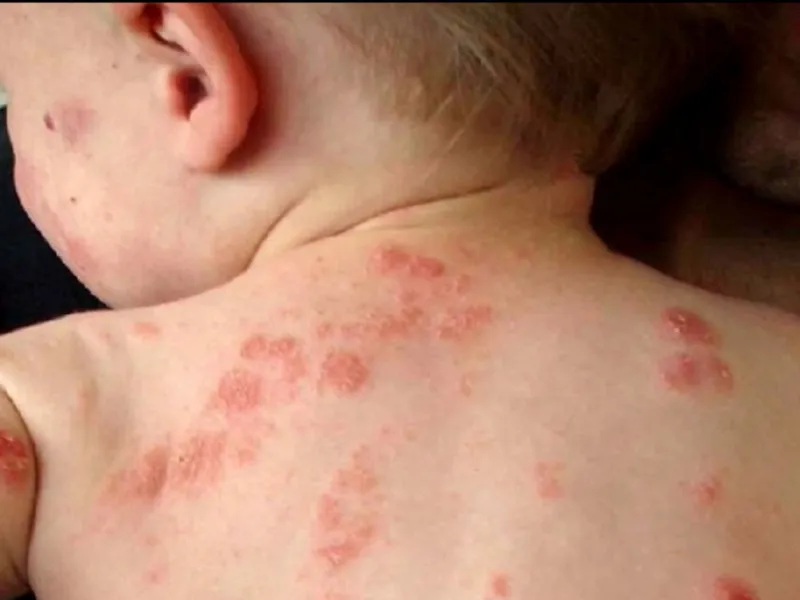 trẻ Nhiễm khuẩn da