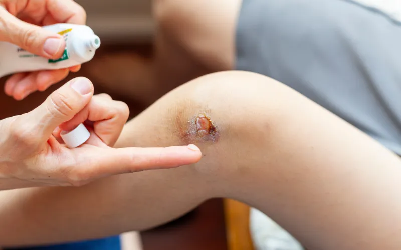 Trẻ bị trầy xước da nên bôi gì để da mau phục hồi và thường được sử dụng