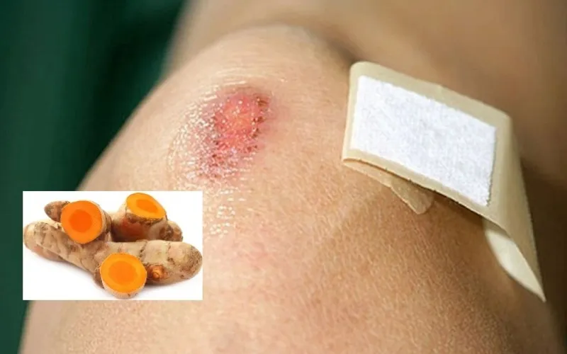 Tự ý áp dụng mẹo dân gian