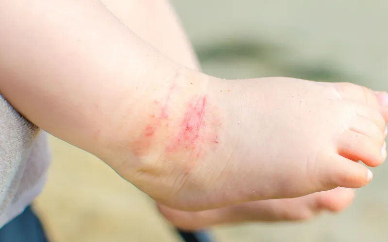 Để bé gãi hoặc chà vào vết trầy