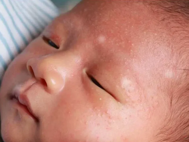 Nguyên nhân khiến trẻ sơ sinh bị lang trắng ở mặt
