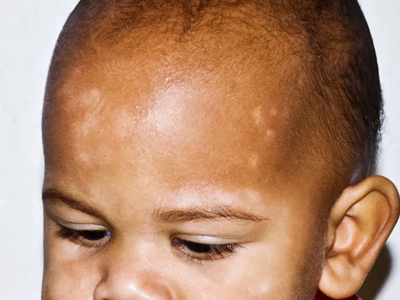 Trẻ sơ sinh bị lang trắng ở mặt