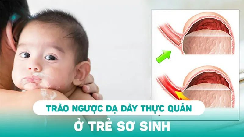 Trào ngược dạ dày thực quản (GERD)