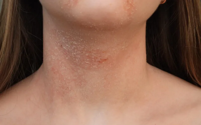 Viêm da cơ địa (Eczema/Atopic Dermatitis)