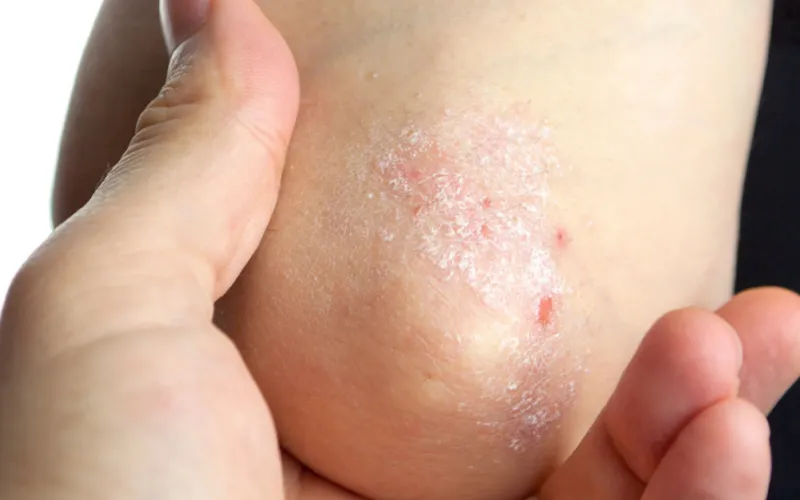 Vảy nến (Psoriasis)