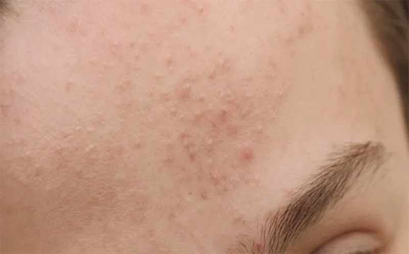 Dấu hiệu da mặt bị nổi sần như da gà và ngứa