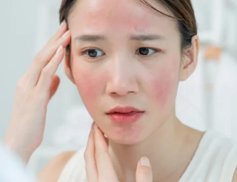 da mặt khô rát đỏ vào mùa đông