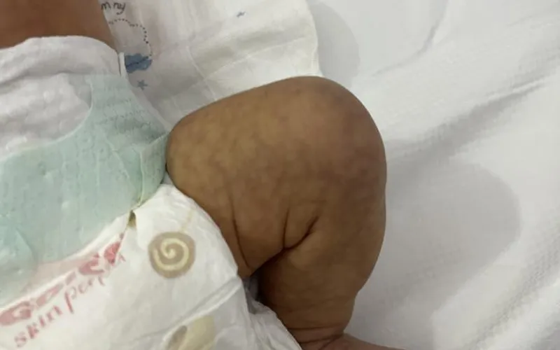 Da trẻ sơ sinh nổi vân hoa là gì?