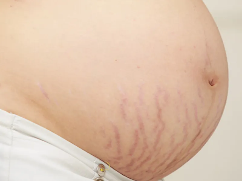 Rạn da đỏ bao lâu chuyển sang màu trắng?