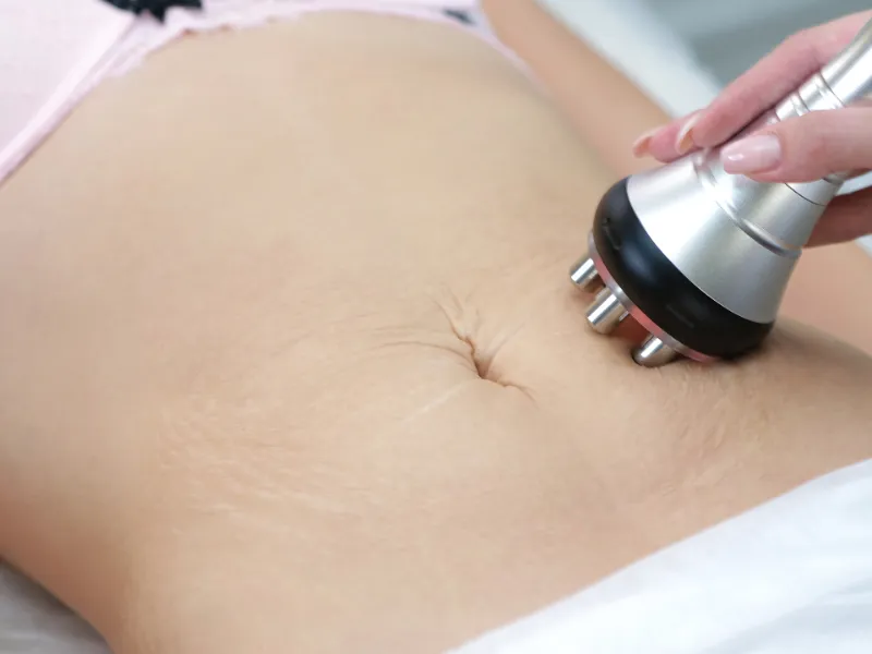 cách xử lý rạn da