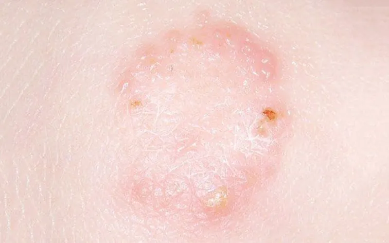 Nhiễm nấm da (hắc lào, lang ben)