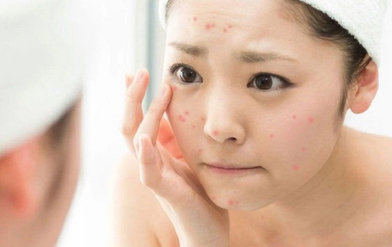 anh-yoosun-acnes-co-day-mun-khong-1
