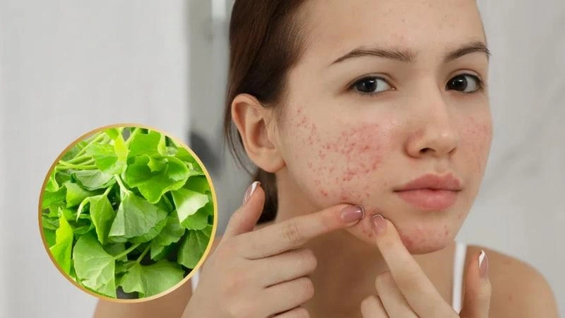 anh-yoosun-acnes-co-day-mun-khong-2