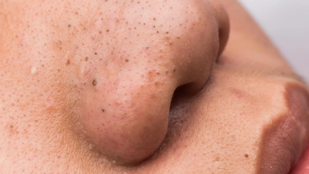 anh-yoosun-acnes-co-day-mun-khong 3