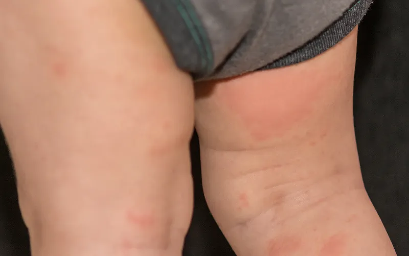 Phân biệt Dị ứng bỉm (Viêm da tiếp xúc) và Hăm tã phổ biến. Bé bị dị ứng bỉm bôi kem gì