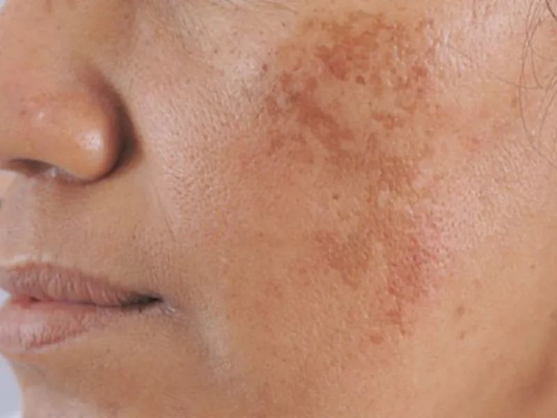 Nám da mặt là gì?