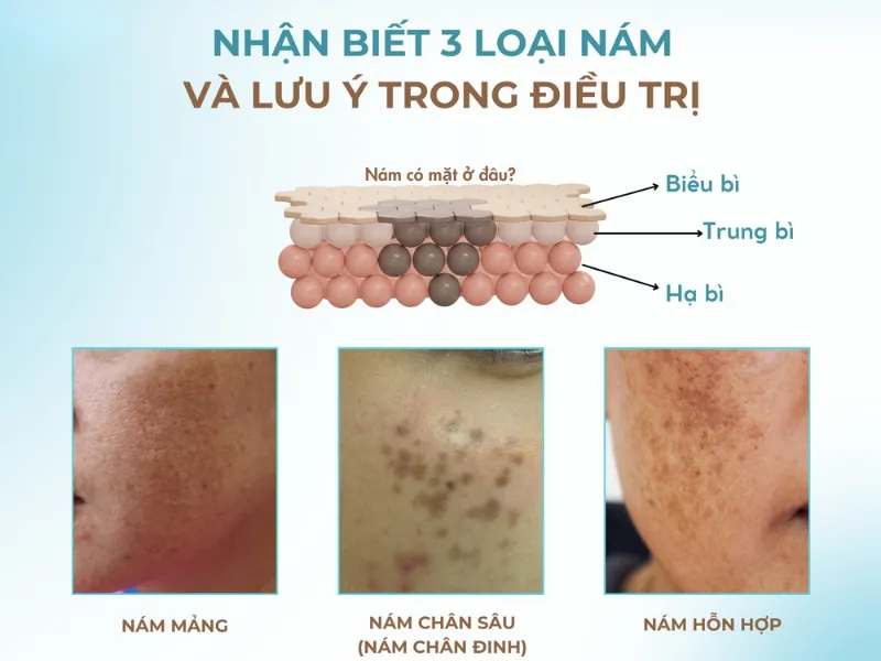 Bị nám da mặt phải làm sao?