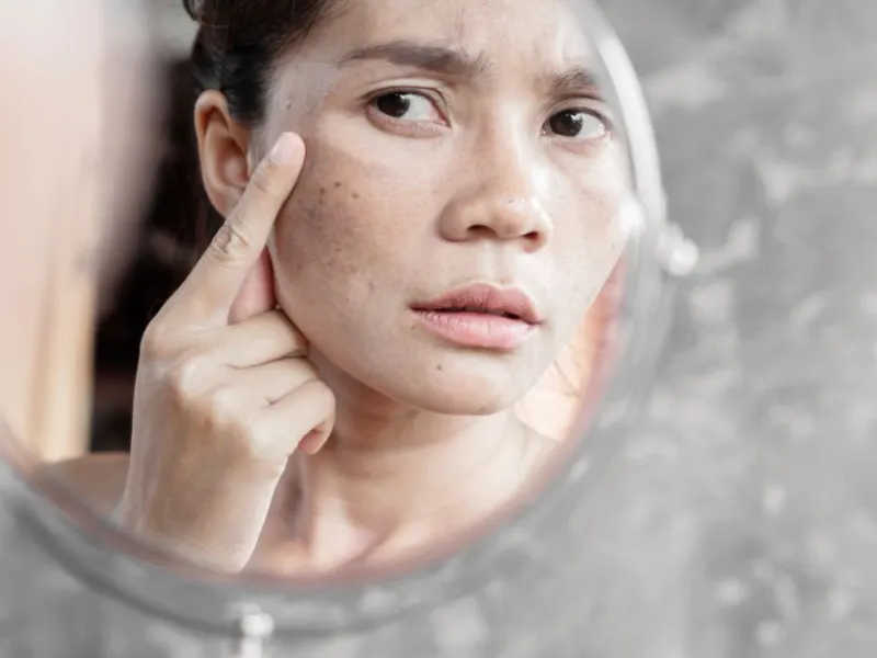 Bị nám da mặt phải làm sao?