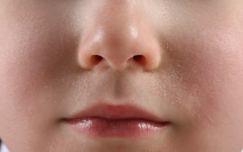 Da hanh khô là gì và vì sao dễ khô căng?