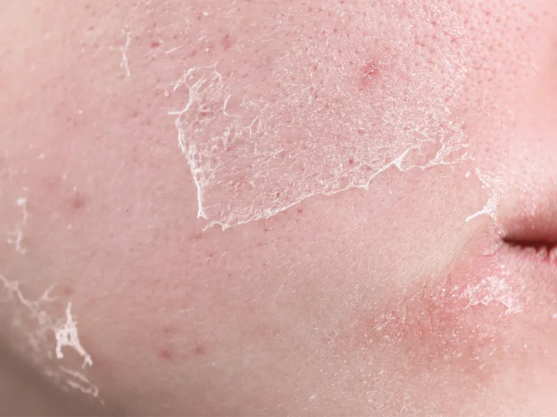 Những sai lầm khi cấp ẩm cho da