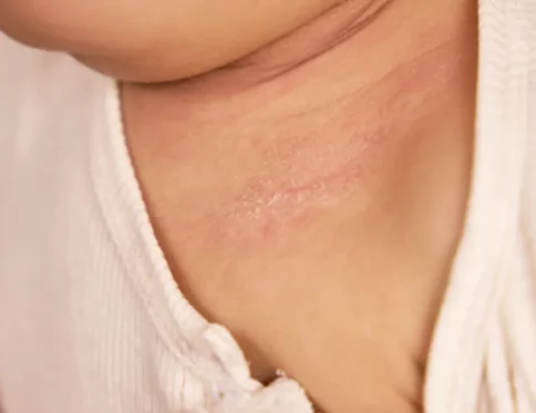 da bé bị khô từng mảng