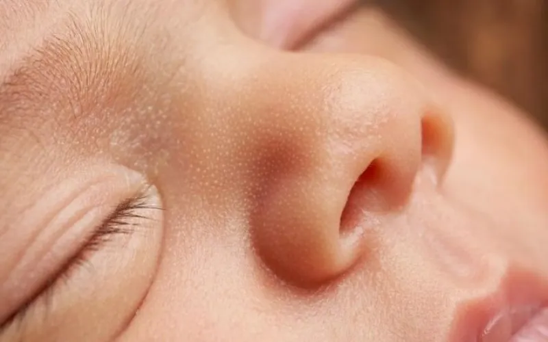 Dấu hiệu nhận biết da khô sần ở bé