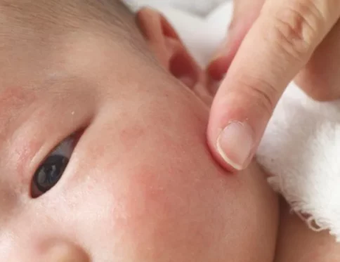 Da em bé bị khô sần