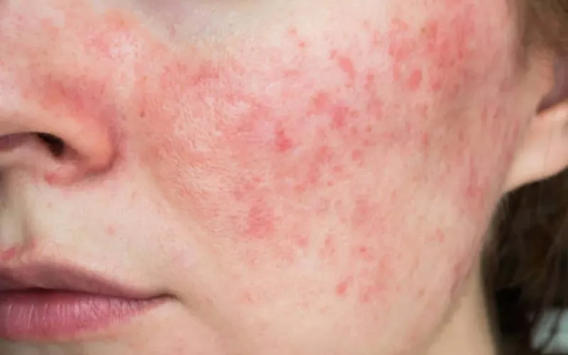 Da đang viêm hoặc nhạy cảm tạm thời