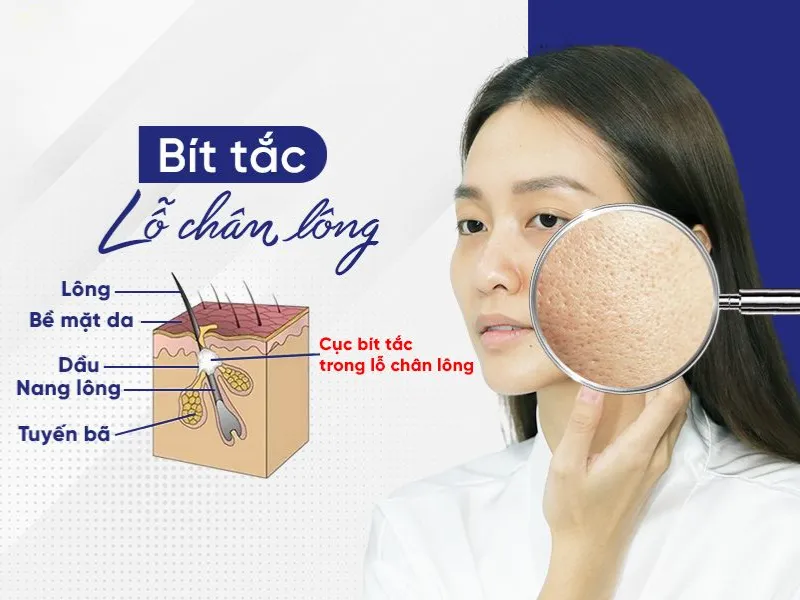 Dimethicone gây bít tắc lỗ chân lông 