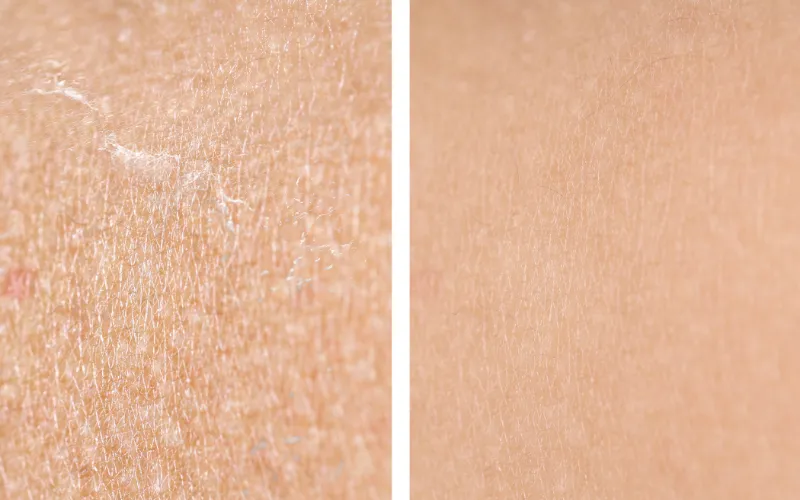 Cơ chế thay mới tế bào khi dùng retinol bị khô da