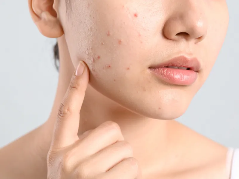 Glycerin trong mỹ phẩm có phù hợp với da dầu, da mụn không?