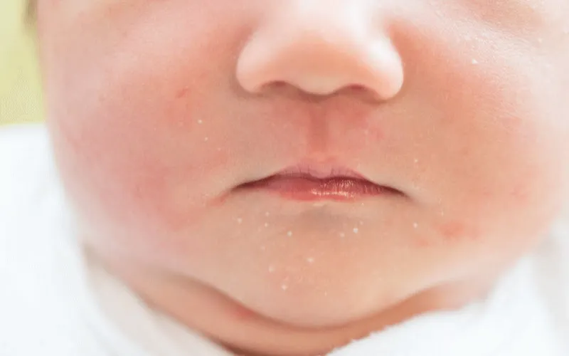 Nhận diện qua hình ảnh trẻ sơ sinh bị mụn sữa thực tế