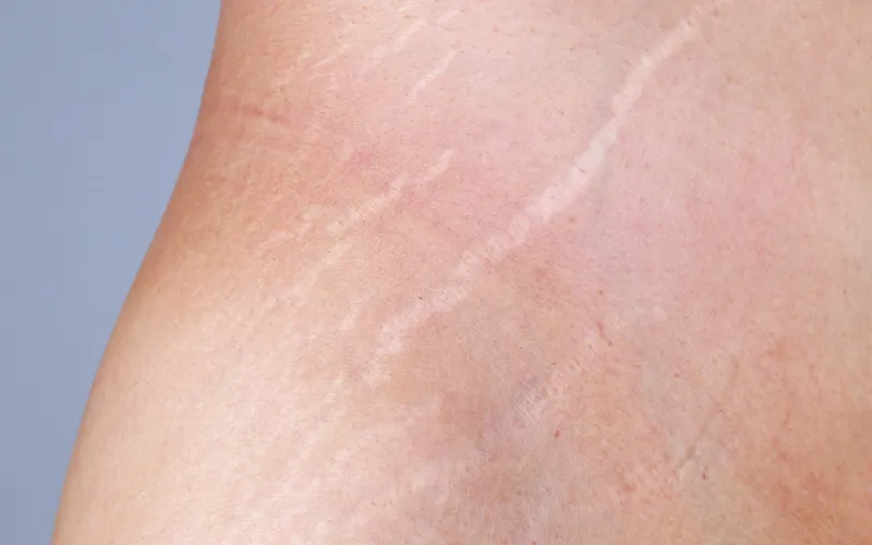 Khả năng phục hồi của vết rạn