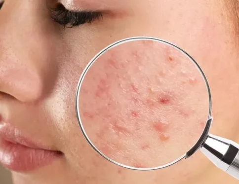 sữa rửa mặt cho da dầu mụn nhạy cảm