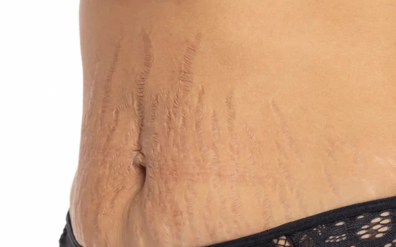 Tìm hiểu cơ chế tại sao bị rạn da