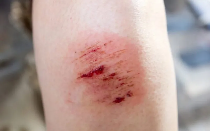 Phân loại vết thương và chỉ định sử dụng