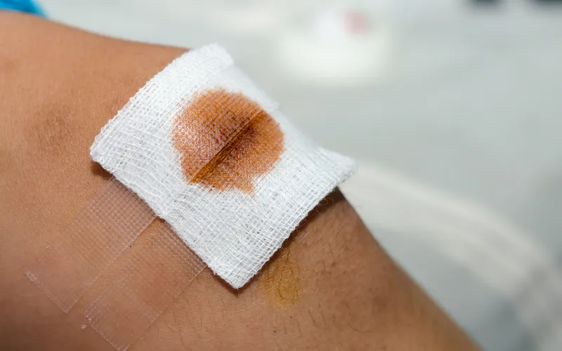 Chăm sóc vết thương trước khi bôi kem nghệ