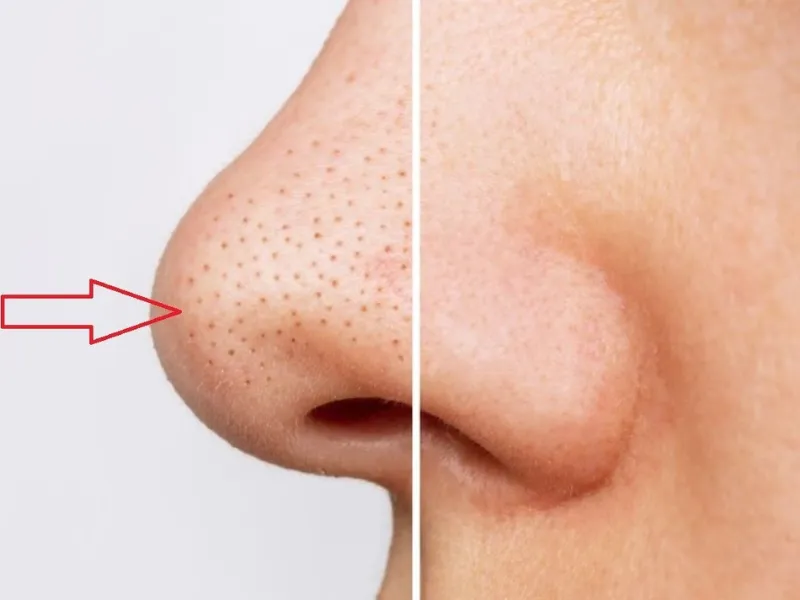 zinc sulfate trong mỹ phẩm