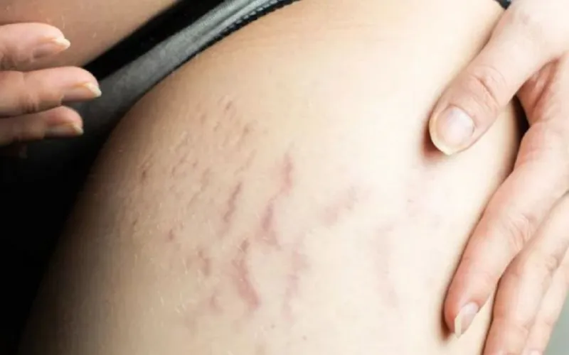 Vùng đùi và mông