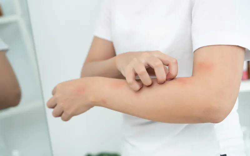 Nhạy cảm ánh sáng do yếu tố nội sinh và di truyền