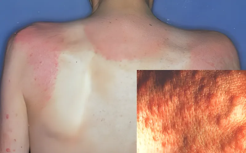 Phát ban ánh sáng đa dạng (PMLE)