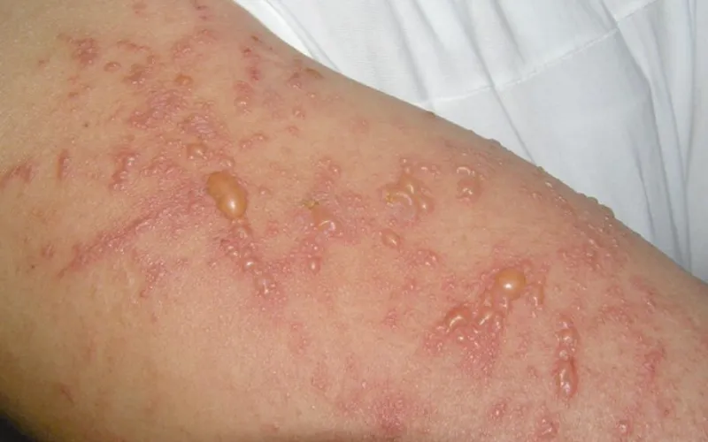 Phản ứng nhiễm độc ánh sáng (Phototoxicity)