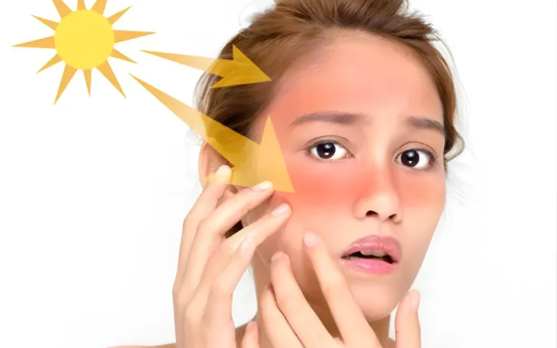 Dị ứng ánh sáng (Photoallergy)