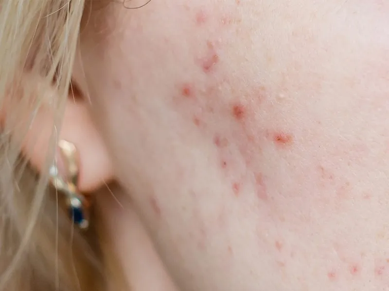 chăm sóc da cho bà bầu 3 tháng đầu