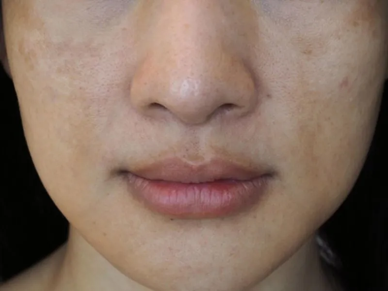 Biểu hiện của da không đều màu