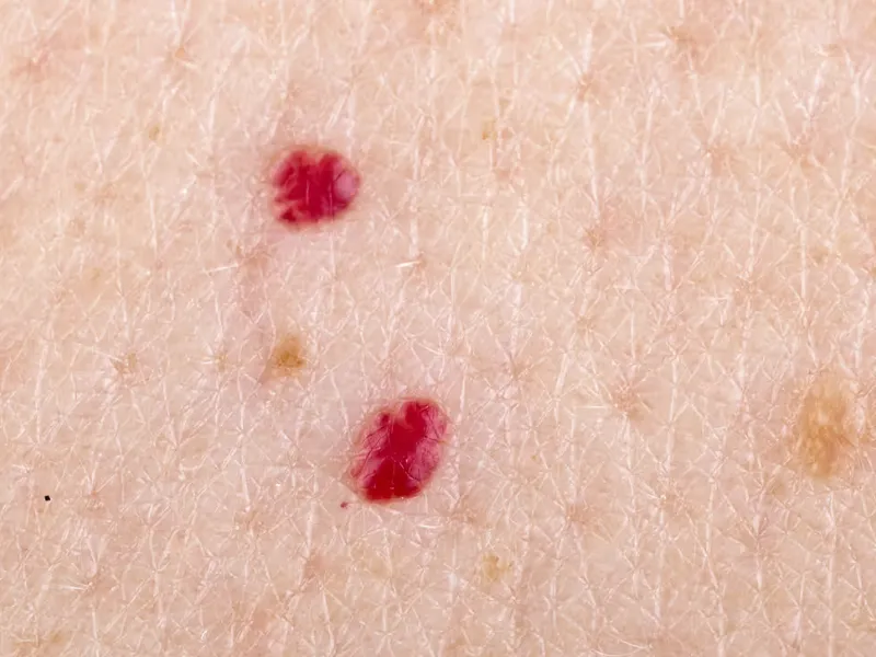 Xuất hiện u mạch máu hình quả anh đào (Cherry Angioma)