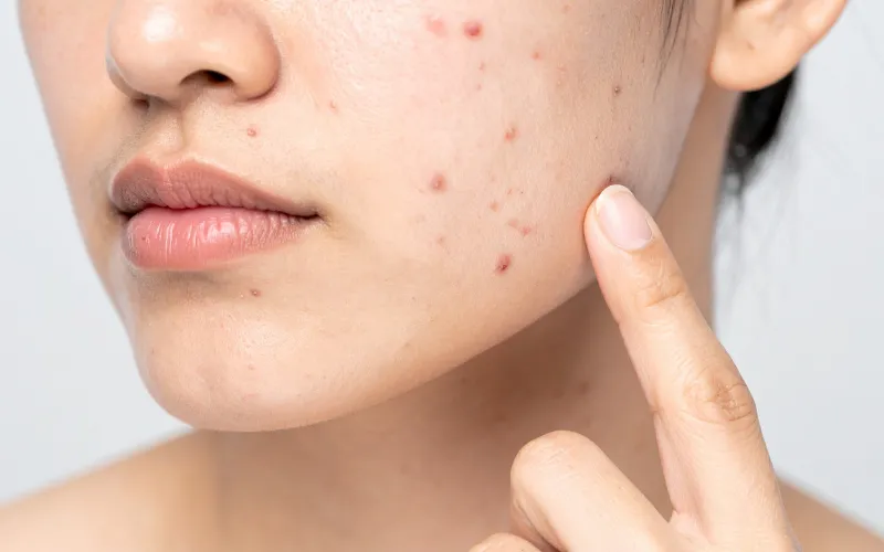 Da dễ nổi mụn