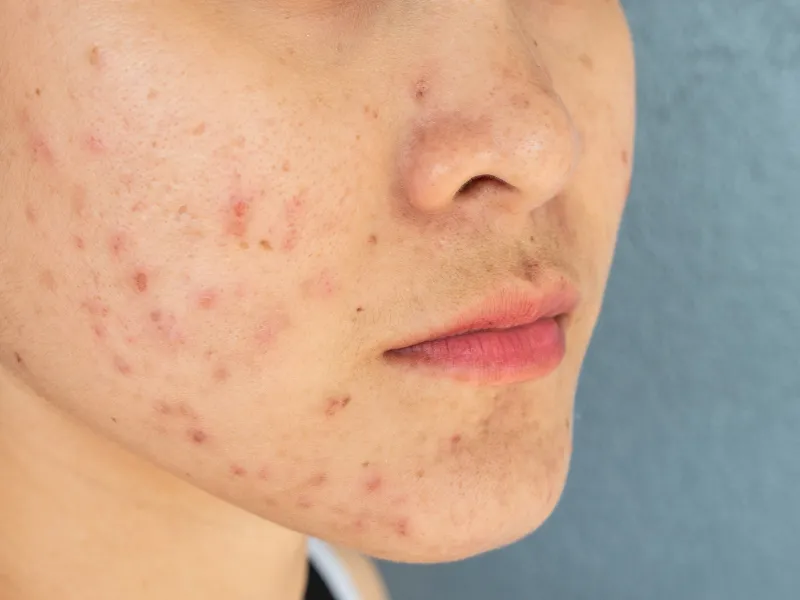 4 lý do nên bôi kem chống nắng sau khi nặn mụn