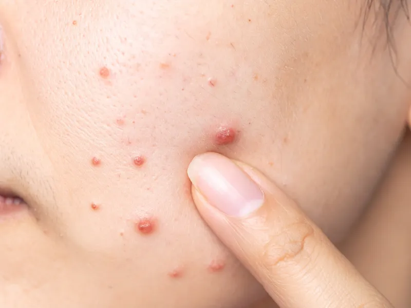 Mới nặn mụn có nên bôi kem chống nắng không?